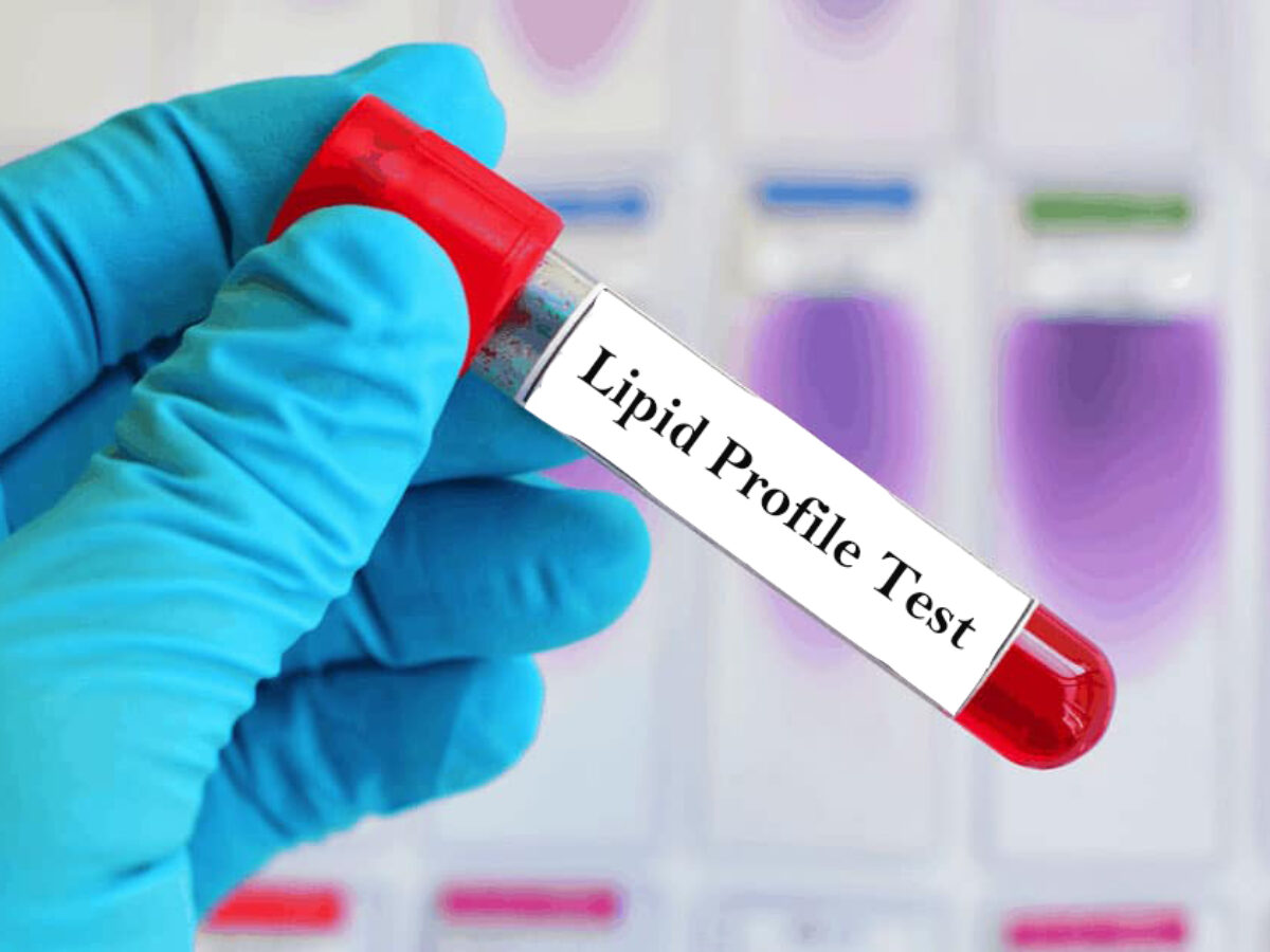 Lipid panel blood test